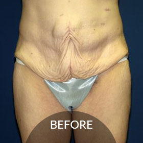 before after photos liposuction