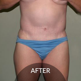 before after photos liposuction