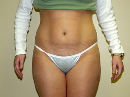 Liposuction Before & After Patient #3775