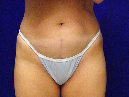 Liposuction Before & After Patient #3698