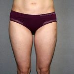 Liposuction Before & After Patient #3674