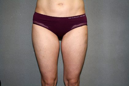 Liposuction Before & After Patient #3674
