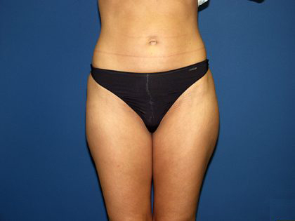 Liposuction Before & After Patient #3744