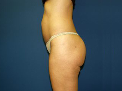 Liposuction Before & After Patient #3744