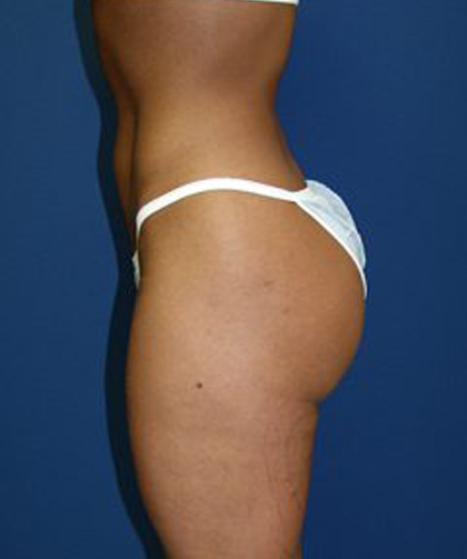 Liposuction Before & After Patient #3613