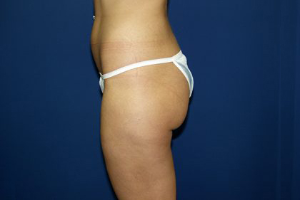 Liposuction Before & After Patient #3638