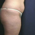 Tummy Tuck Before & After Patient #1804