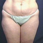 Tummy Tuck Before & After Patient #1804