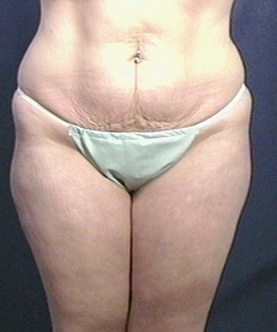 Tummy Tuck Before & After Patient #1804