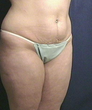 Tummy Tuck Before & After Patient #1804