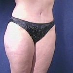 Tummy Tuck Before & After Patient #1804