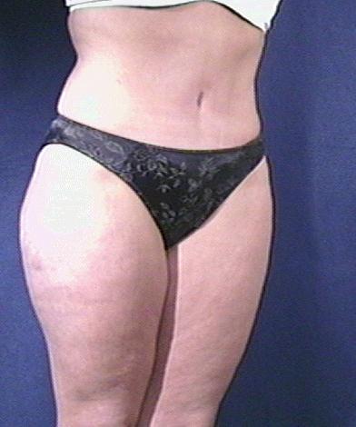 Tummy Tuck Before & After Patient #1804