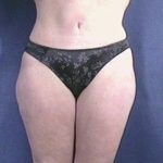 Tummy Tuck Before & After Patient #1804