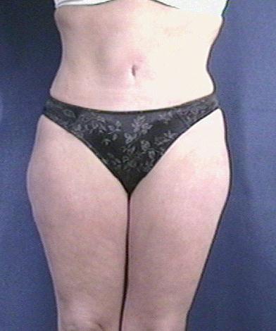 Tummy Tuck Before & After Patient #1804
