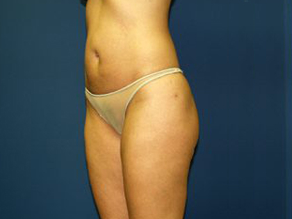 Liposuction Before & After Patient #3744