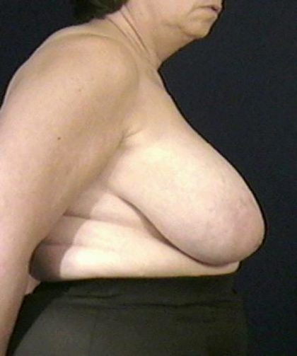 Breast Reduction Before & After Patient #3517