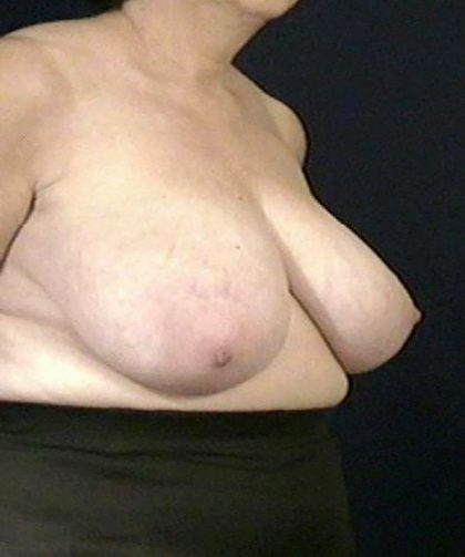 Breast Reduction Before & After Patient #3517