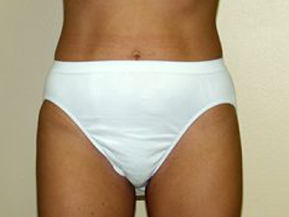 Liposuction Before & After Patient #3698