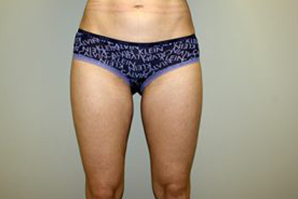 Liposuction Before & After Patient #3674