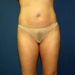 Liposuction Before & After Patient #3744