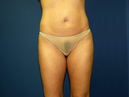 Liposuction Before & After Patient #3744