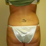 Liposuction Before & After Patient #3775