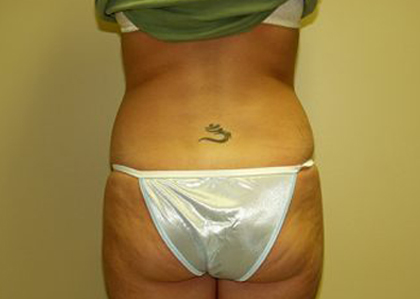 Liposuction Before & After Patient #3775