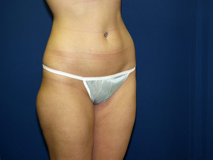 Liposuction Before & After Patient #3638