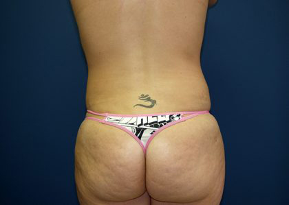 Liposuction Before & After Patient #3775