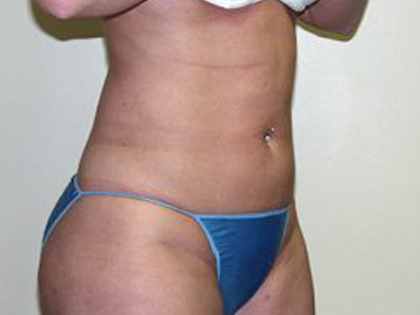 Liposuction Before & After Patient #3720