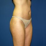 Liposuction Before & After Patient #3744