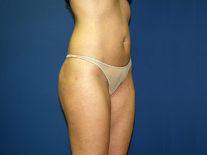 Liposuction Before & After Patient #3744