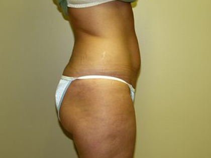 Liposuction Before & After Patient #3775