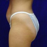 Liposuction Before & After Patient #3698