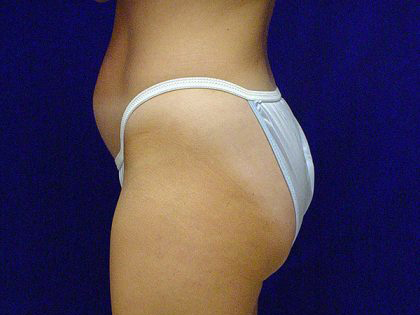 Liposuction Before & After Patient #3698