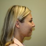 Chin Lipo Before & After Patient #3763