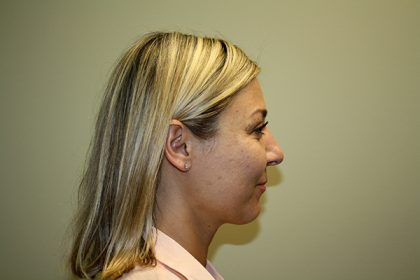 Chin Lipo Before & After Patient #3763