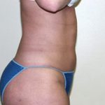 Liposuction Before & After Patient #3720