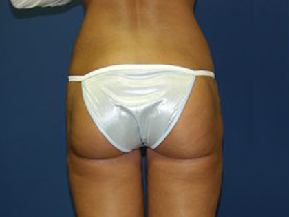 Liposuction Before & After Patient #3638