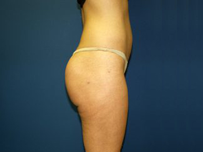 Liposuction Before & After Patient #3744