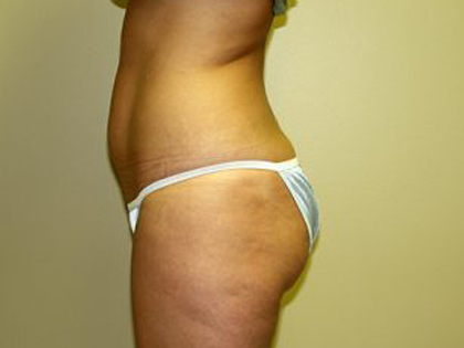 Liposuction Before & After Patient #3775