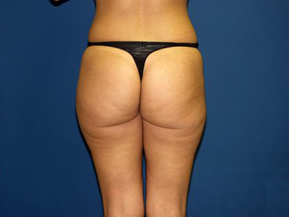 Liposuction Before & After Patient #3744