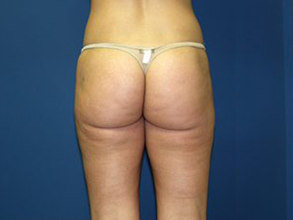 Liposuction Before & After Patient #3744