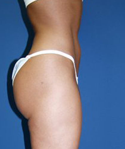 Liposuction Before & After Patient #3613