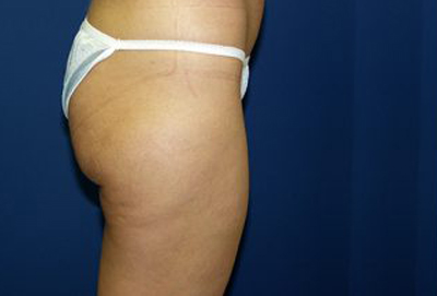 Liposuction Before & After Patient #3638