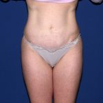 Tummy Tuck Before & After Patient #1905