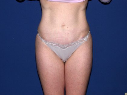 Tummy Tuck Before & After Patient #1905