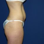 Tummy Tuck Before & After Patient #1905