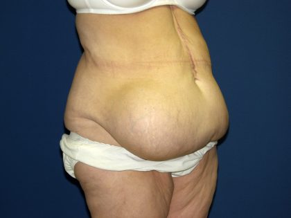 Circumferential Tummy Tuck Before & After Patient #898