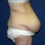 Circumferential Tummy Tuck Before & After Patient #898